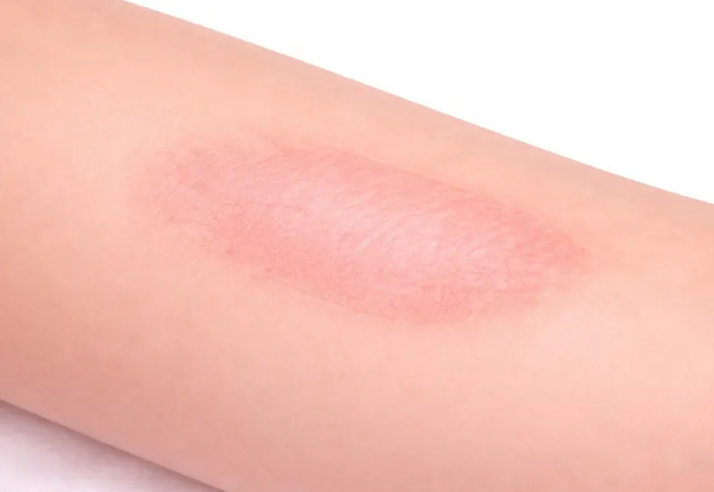 화상 흉터 관리 및 재활 치료