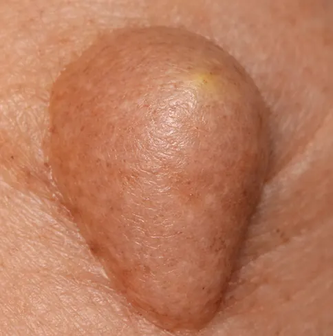 지방종 피부종양