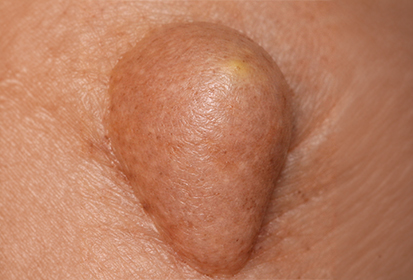 지방종 (Lipoma)