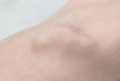 결절종 (Ganglion Cyst)